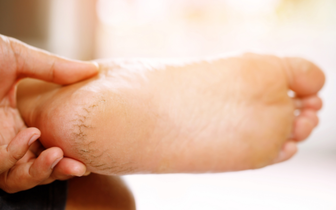 Best Foot Crack Creams In India